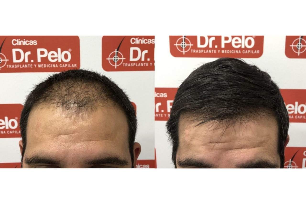 Señales de alopecia Clínicas Dr. Pelo