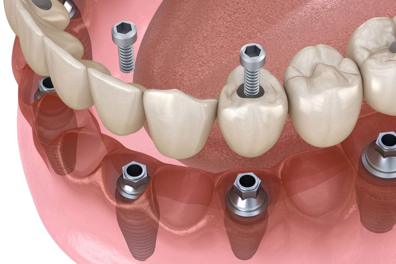 Helident Training Center: ¿Los implantes duran para siempre?¿Qué cuidados necesitan? Por Helident Training Center