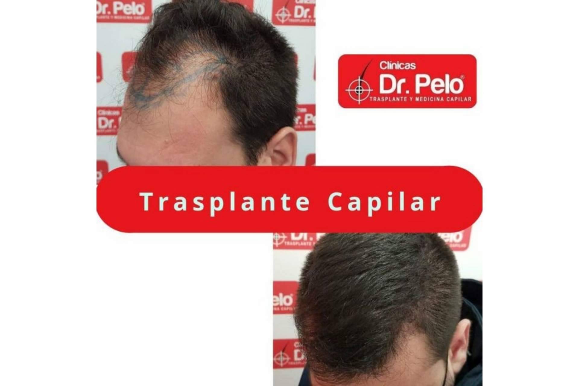 Un tratamiento como el injerto capilar en Sevilla gana popularidad gracias a las Clínicas Dr. Pelo