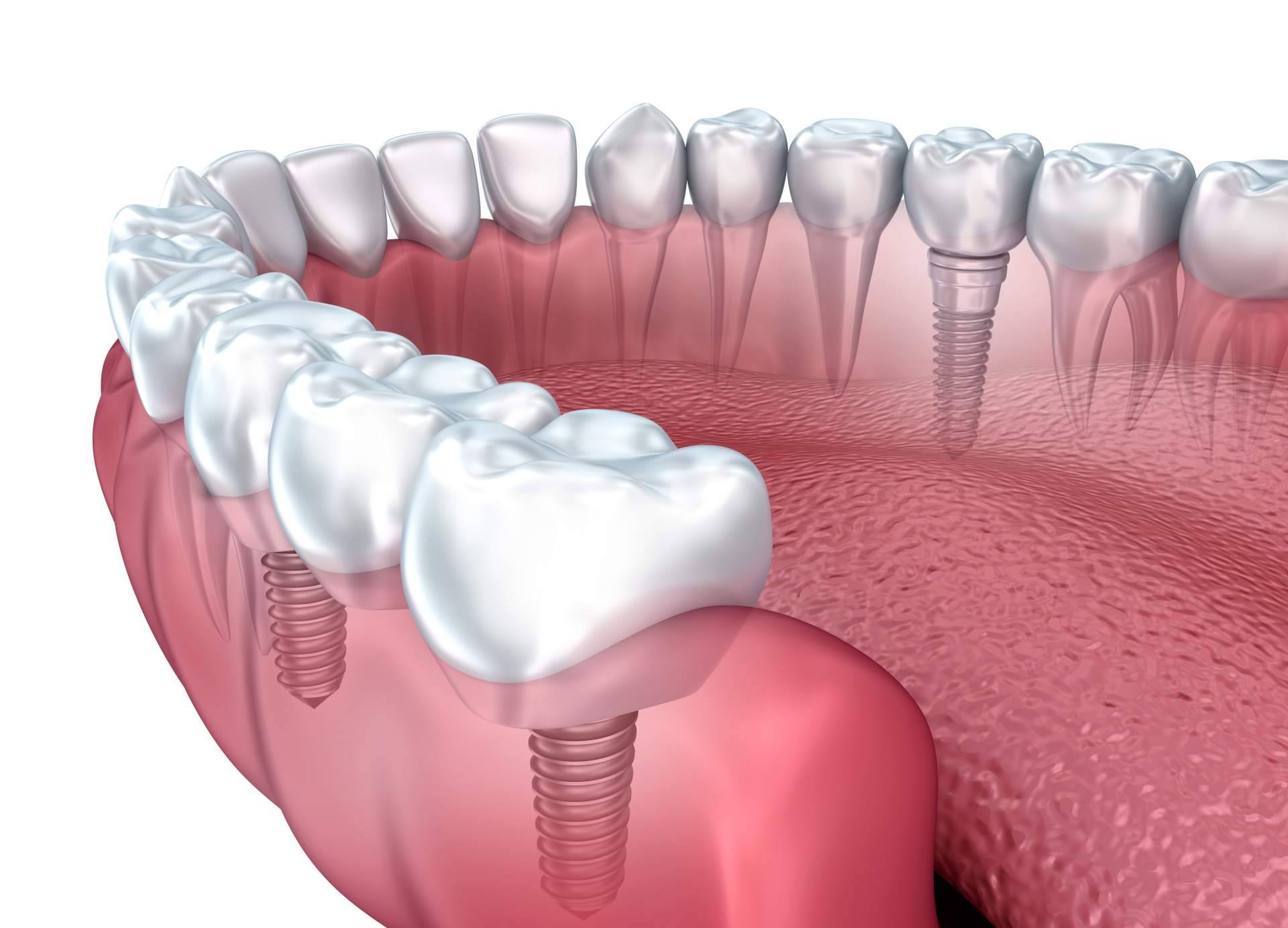 Clínica de Odontología Artydents de Madrid anuncia su implante dental de titanio por solo 199€