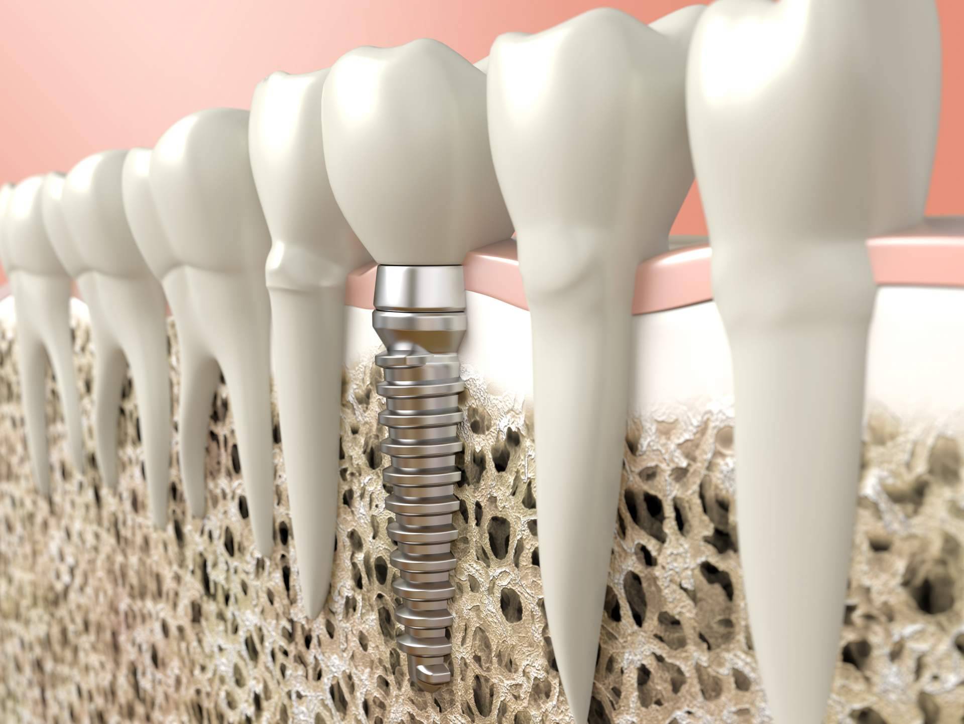 ¿Dónde encontrar tratamiento de implantes dentales y ortodoncia invisible? Clínica Dental Heins
