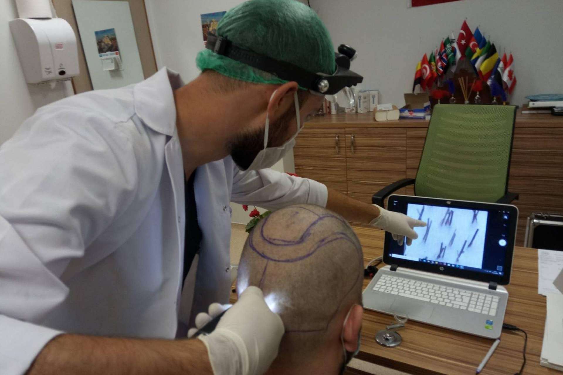 Injerto capilar Turquía todo incluido: FUE Hair Transplant System