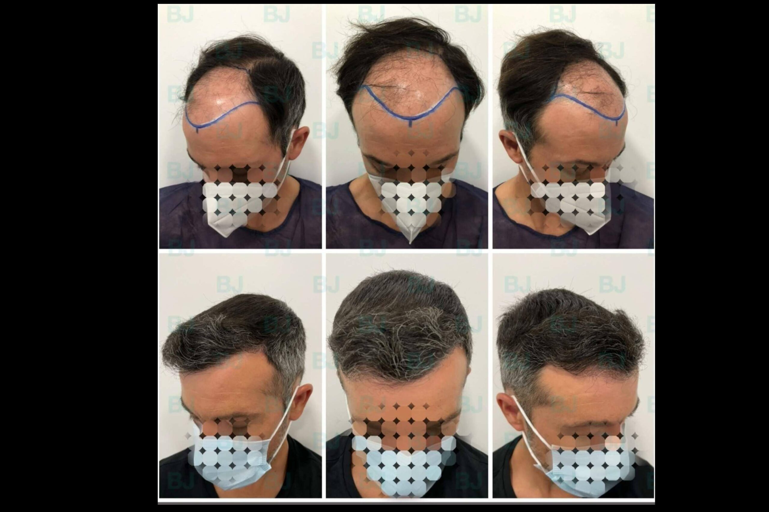 Dr. Bruno Jacobovski, especialista en injerto capilar en Barcelona con más de 500 intervenciones de éxito