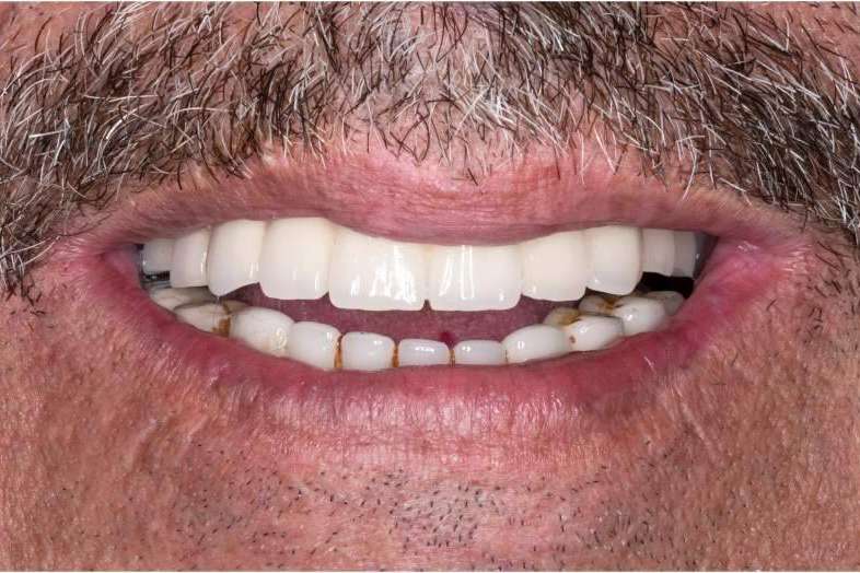 La clínica dental en Madrid Bordonclinic lleva a cabo rehabilitaciones orales complejas en un día