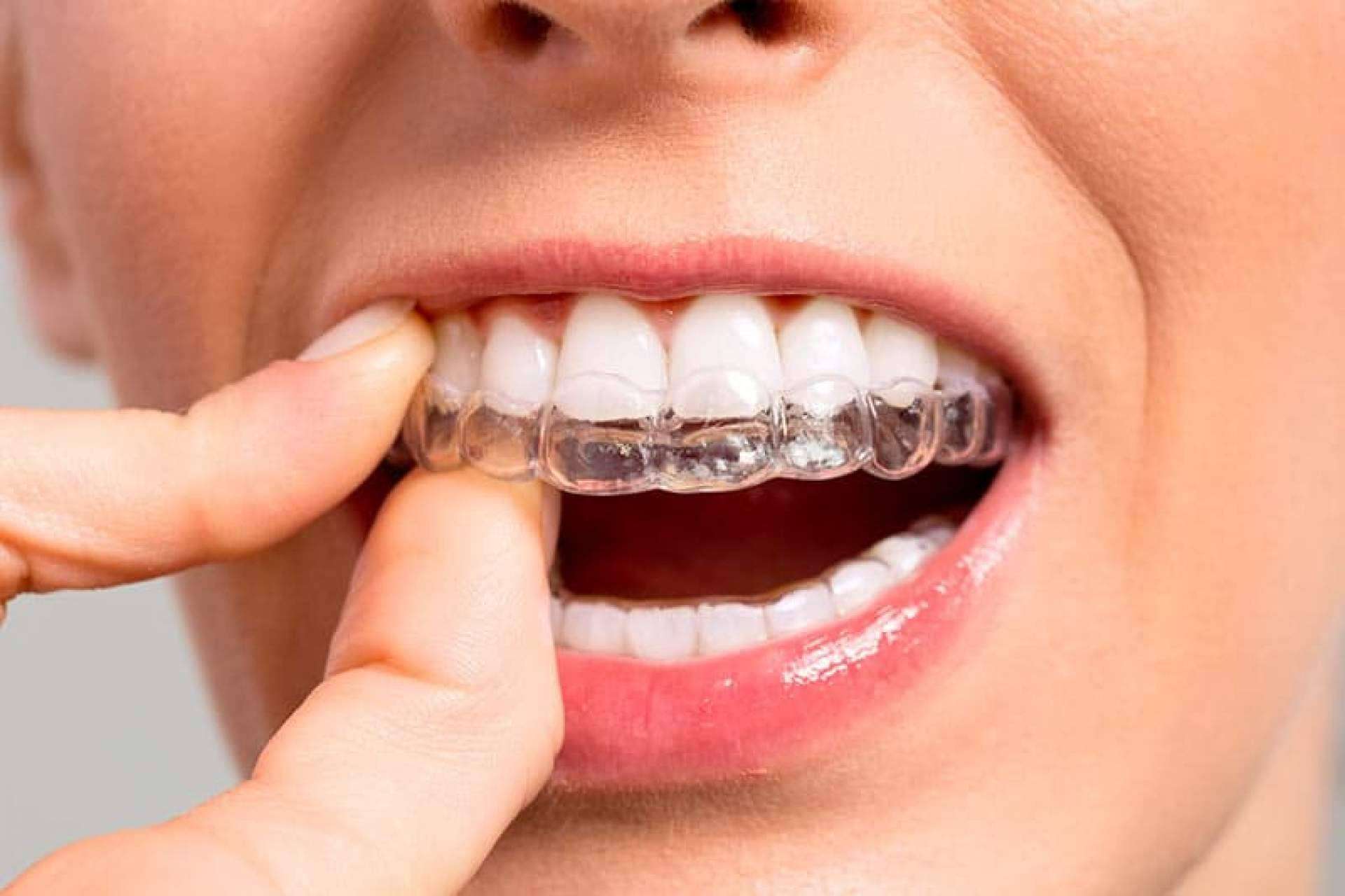 Ortodoncia invisible con Invisalign® en la Clínica Dental Ahoa