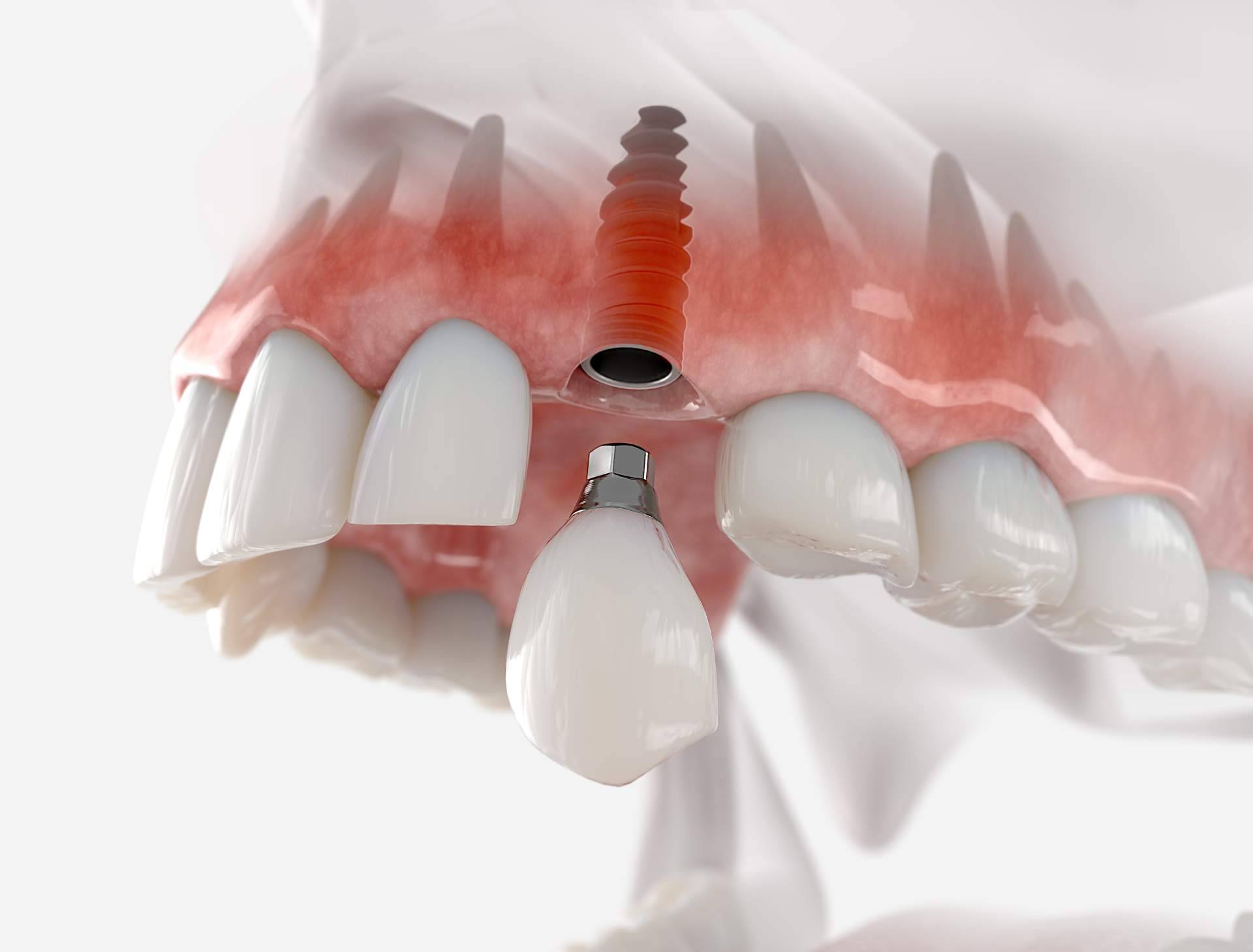 Las consecuencias de la pérdida de un diente, por Dentinova
