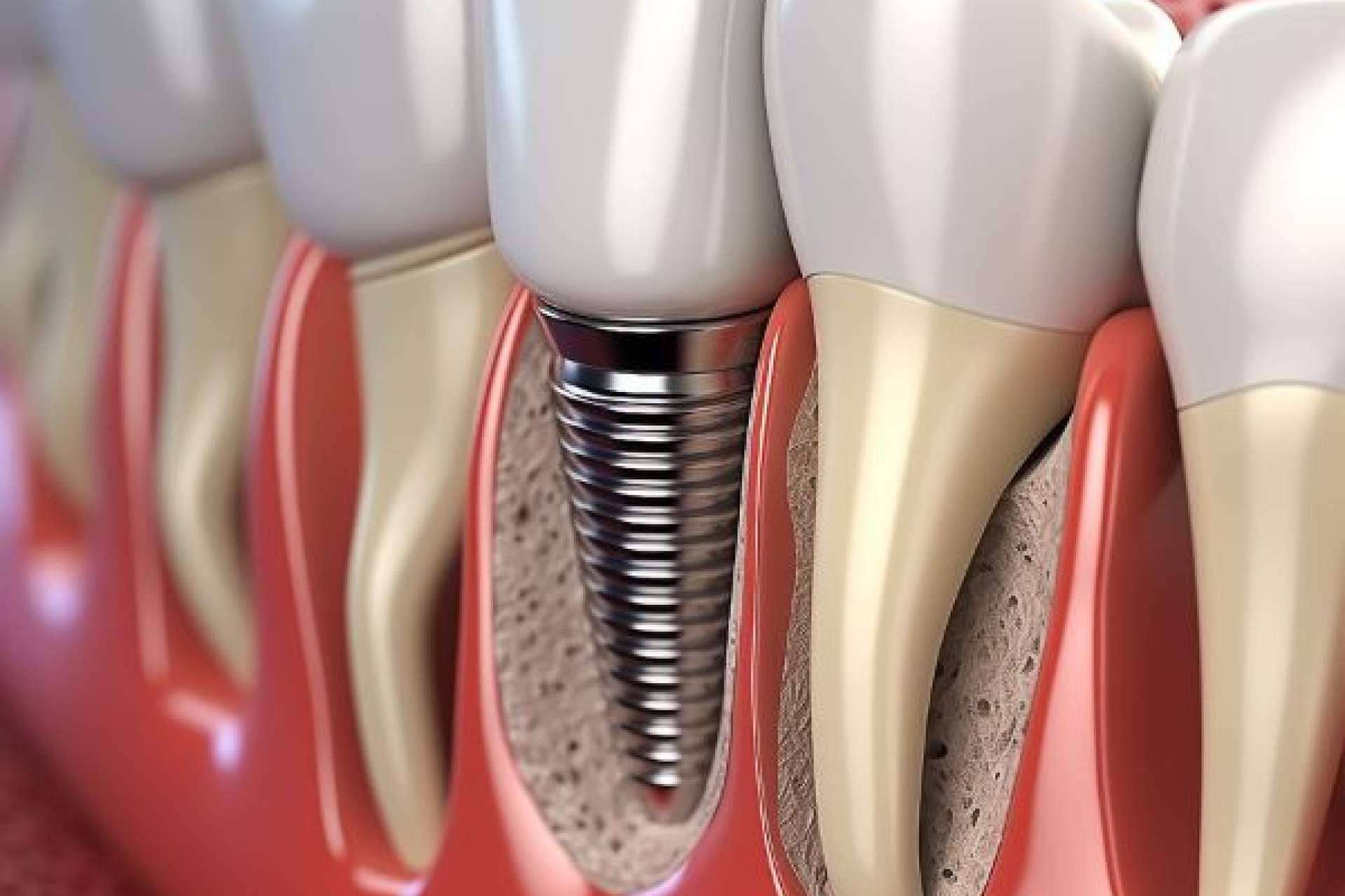 El estándar de calidad en implantes dentales de Denty Dent en Madrid